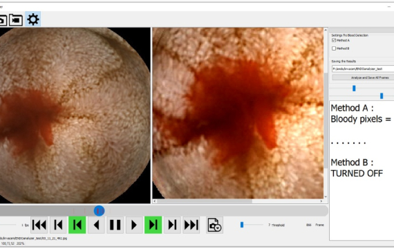 Automatic blood detection in capsule endoscopy video