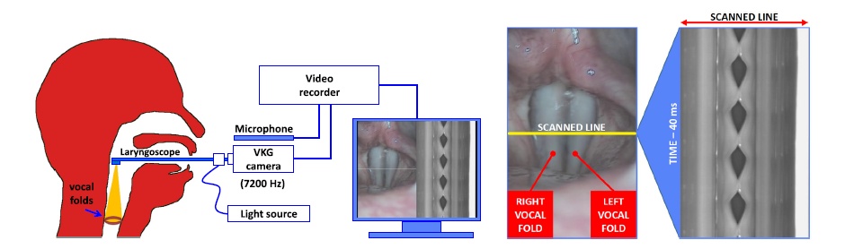 Videokymogram Analyzer Tool: Human–computer comparison