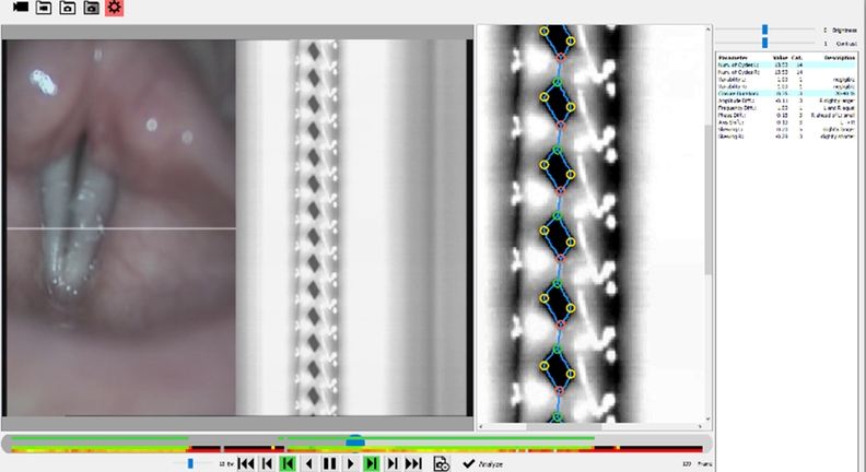 Automatic Evaluation of Videokymographic Records for Early Diagnosis and Prevention of Vocal Cord Cancer